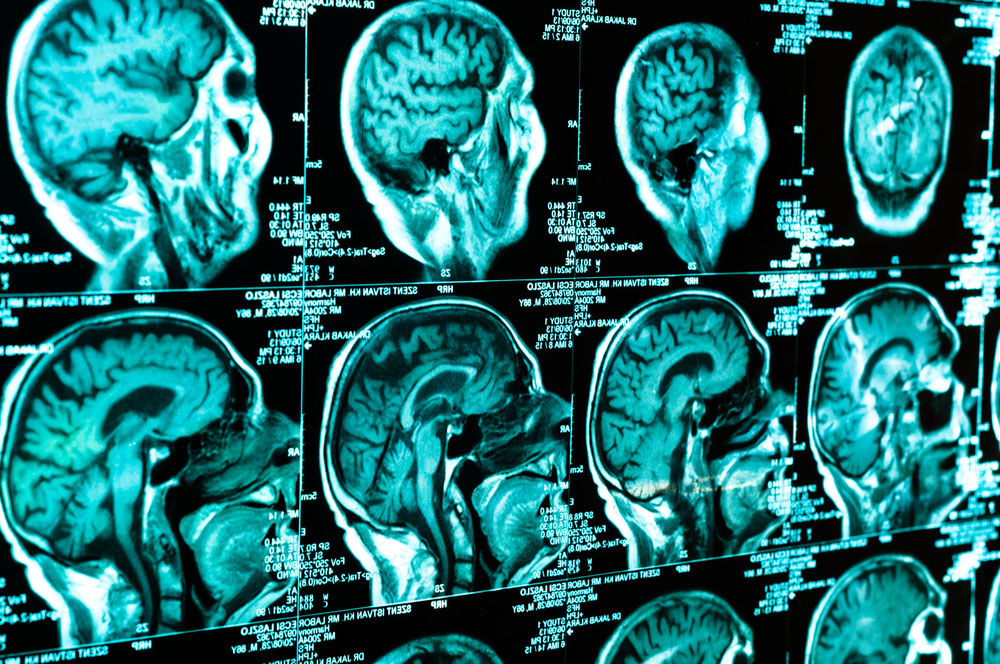 Traumatic Brain Injury And PTSD Often Go Hand In Hand
